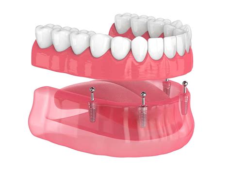 Hybrid Dentures | Dental And Denture Care Center | Spring Hill, Florida