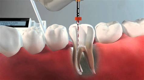 Qué es una endodoncia y para qué sirve Clínica Dental Sevilla