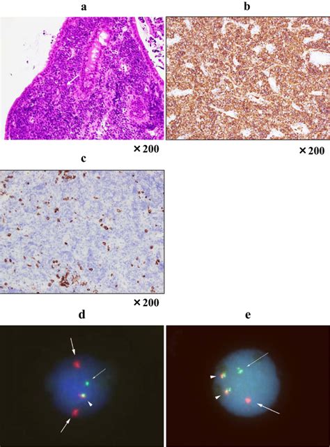 Figure6 Morphologic Suspicion Of A Diffuse Large B Cell Lymphoma Based