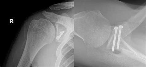 Outcomes Of The Latarjet Procedure Versus Free Bone Block Procedures