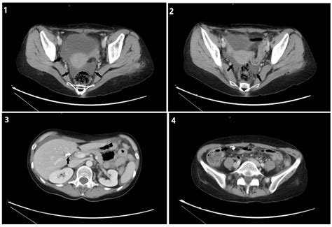 Laparoscopic Wound Leaking at Shirl Ketner blog