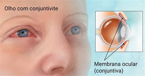 Conjuntivite Entenda O Que E Como Cuidar Jardel Campos