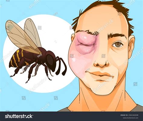 Bee sting. Swollen face. Swollen eye. Injury - Royalty Free Stock ...