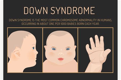 Down Syndrome Symptoms - Health Info