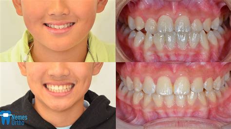 Interceptive Orthodontic Treatment Class Iii Underbite