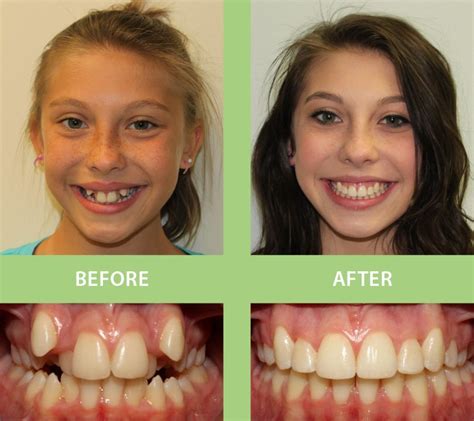 Smile Gallery Prettyman Orthodontics