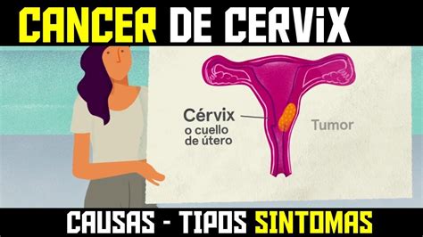 Que Es El Cancer De Cuello Uterino Sintomas Causas Y Tratamiento Youtube