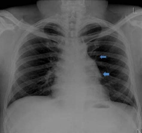 Chest x-ray showing prominence in the left heart border (arrows ...