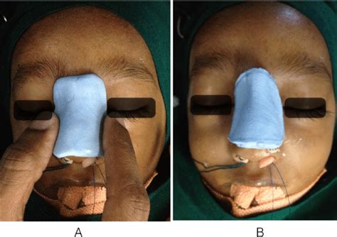 Nasal Splint / Silicone Nasal Splints Medasil Surgical Ltd Leeds : In this video you will see ...