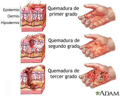 Primeros Auxilios Quemaduras