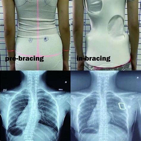 Prebracing And In Bracing Coronal Parameters º Download Scientific