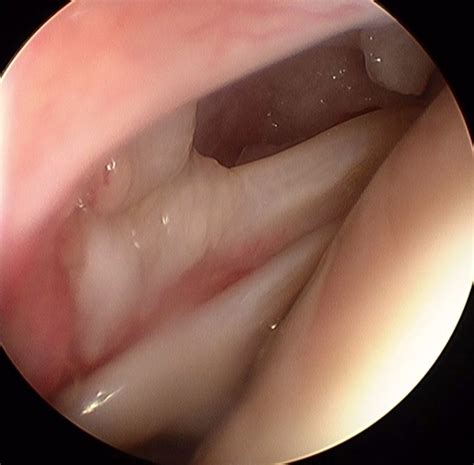 La Tendinitis Calcificante Del Hombro Dr Jose Ignacio Gimeno Abad