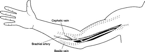 Figure 1 from Transposition of the basilic vein for arteriovenous ...