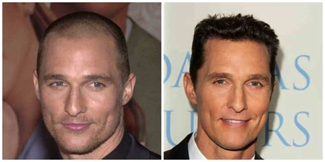 Matthew Mcconaughey Hair Transplant The Truth Revealed