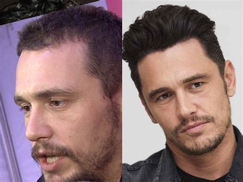 James Franco Hair Transplant Hairstyles Ideas