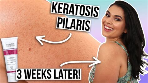 How I Treat My Keratosis Pilaris On Arms No More Dry Bumpy Skin Youtube