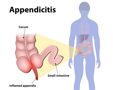 What Side Is Your Appendix On