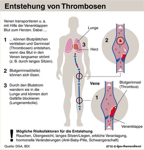 Gefährlicher Pfropf Auf Risiko einer Thrombose achten DER SPIEGEL