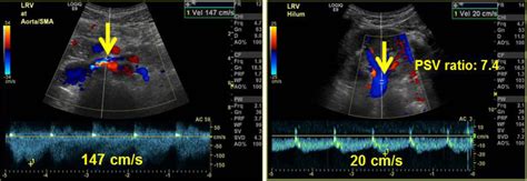 Treatment Of Nutcracker Syndrome With Open And Endovascular