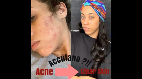 Accutane My Journey To Clearing Cystic Acne Youtube