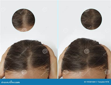 Cabello Calviciado Femenino Antes Del Tratamiento Despu S De La