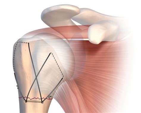 Point Technique Sur Les Ost Osutures Des Fractures De Lextr Mit