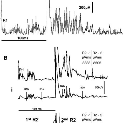 Eeg Emg Polygraphy Recording Of Patient A With Classical Stiff Person Download Scientific