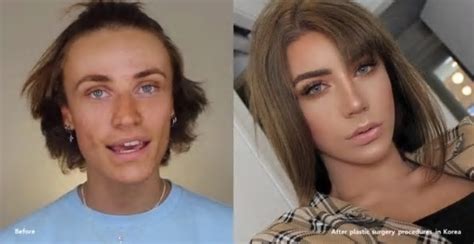 Transgender Genital Surgery Before And After