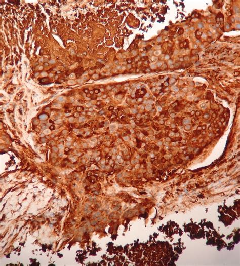 Pathology Outlines Choriocarcinoma