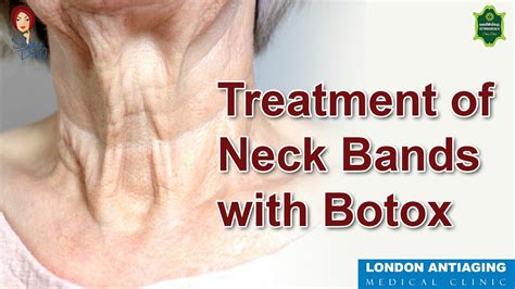 Treatment Of Neck Bands With Botox Youtube