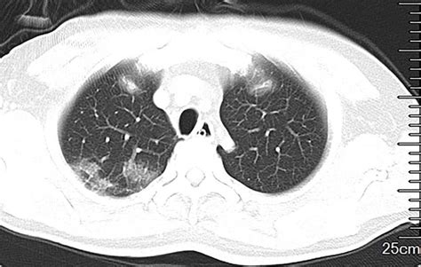 CT Of Chest Shows Patchy Ground Glass Opacities In Right Upper Lung