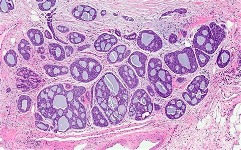 Pathology Outlines Adenoid Cystic