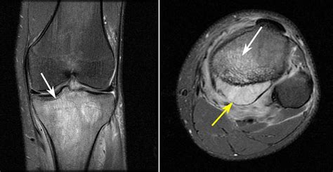 Primary Lymphoma Of Bone OrthoInfo AAOS