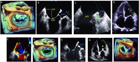 Transesophageal Echocardiogram Tee Pre Procedural Assessment And Download Scientific Diagram