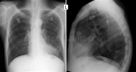 X-ray of the Lungs. Post-tuberculosis Changes Stock Photo - Image of ...