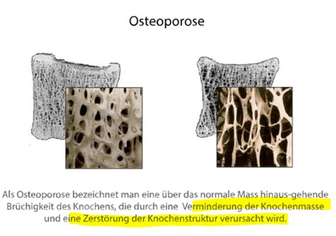 Osteoporose Karteikarten Quizlet