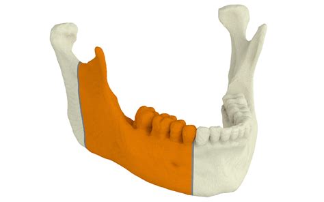 Custom Mandible Reconstruction Plate Xilloc