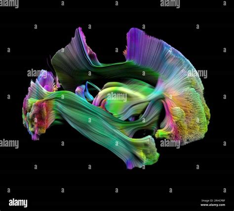 White Matter Fibres Dti Mri Scan Stock Photo Alamy