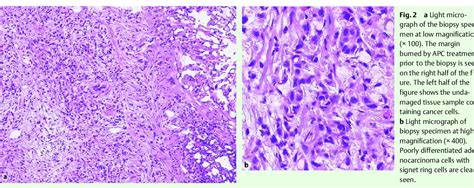 Figure From Utility Of Endoscopic Pinch Biopsy After Argon Plasma