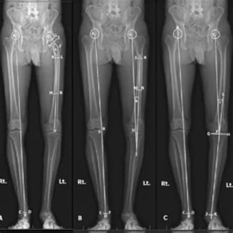 X Ray Both Lower Limb Test Price In Delhi Ganesh Diagnostic