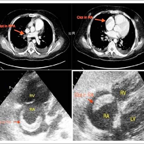 Computed Tomography Of The Chest Top Panel Showing Filling Defects In