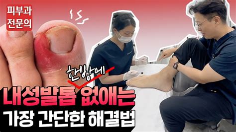 내성 발톱 멈춰 원장님이 직접 체험해 본 초간단 내성 발톱 치료법🦶 피부과 전문의 노성민 Youtube