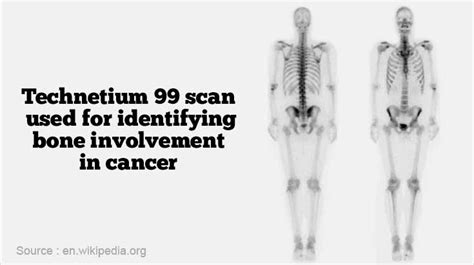 Radioisotope Scan And Advantage Of Using Technetium 99m Isotope