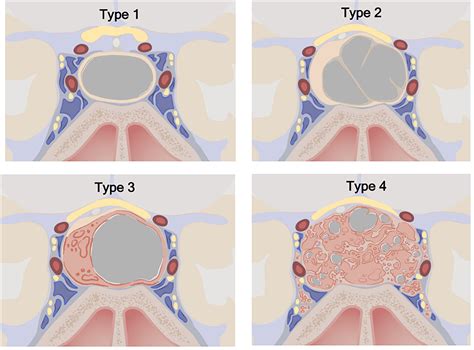 Frontiers Cyst Type Differentiates Rathke Cleft Cysts From Cystic