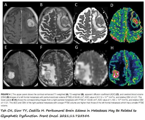 Edema Cerebral Concepto Consecuencias Y Tipos