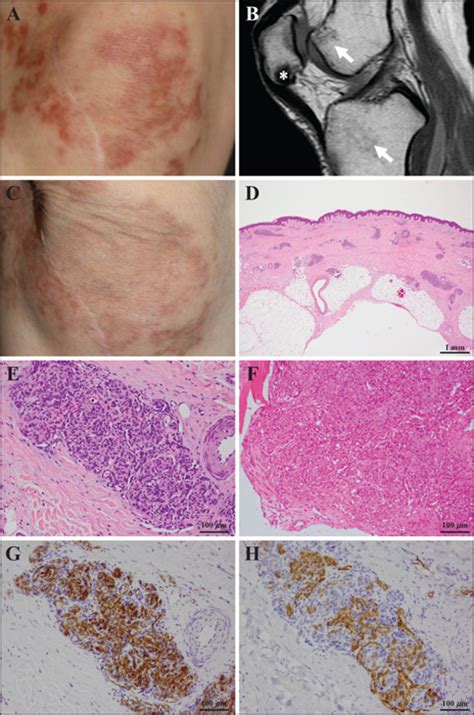 JLE European Journal Of Dermatology An Intermediate Vascular Tumour