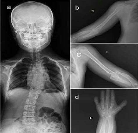 Radiological features of Robinow syndrome seen in this patient ...