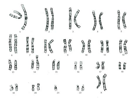 Down Syndrome Karyotype Translocation