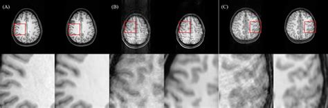 Figure From Motion Correction For Brain Mri Using Deep Learning And A