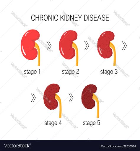 Chronic Kidney Disease Royalty Free Vector Image